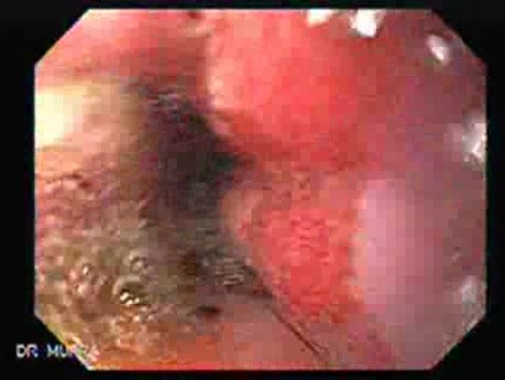 Gastroesophagic Varices - 66 - Year - Old Man (4 of 7) 