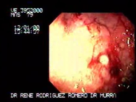 Adenocarcinoma of the Corpus and Antrum