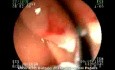 Giant Duodenal Papilla Tumor