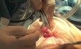 Contained Morcellation of Large Uterus