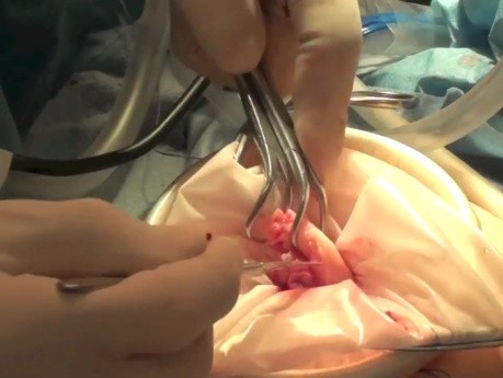 Contained Morcellation of Large Uterus