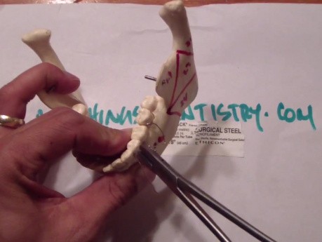 Mandible Fracture - Ivy Loop Fixation - Mandible Practice