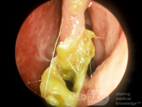 Atrophic Rhinitis [ozena]