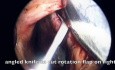 Nasal Septal Perforation Repair