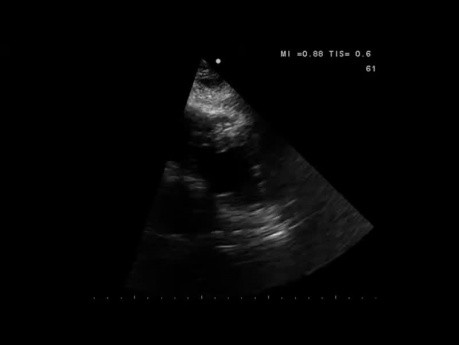 ECG and Echocardiography of a Patient With LV Wall Motion Abnormalities