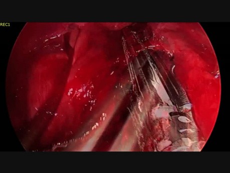 Non Intubated Uniportal VATS Left Lower Lobectomy
