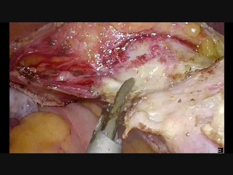 TLH for Prev 2 LSCS, Bladder Densely Adherent, Clean Dissection