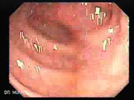 Adenocarcinoma of the Transverse Colon (2 of 5)