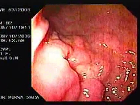 Irregular Ulcer at the Corpus - 92 Years-Old Male