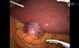 Robotic Cholecystectomy, ICG, IOC for Acute Cholecystitis