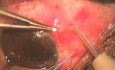 Glaucoma Surgery - Failed Surgery With Drainage Of Both Eye Chamber
