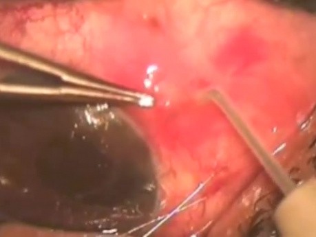Glaucoma Surgery - Failed Surgery With Drainage Of Both Eye Chamber
