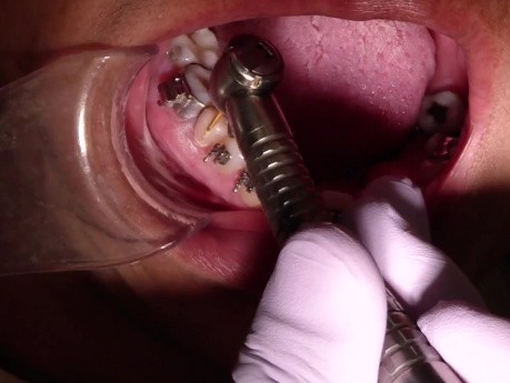 The Trick To Removing Composite From Enamel