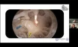 Round Window Anatomy and Endoscopic Assisted Cochlear Implant