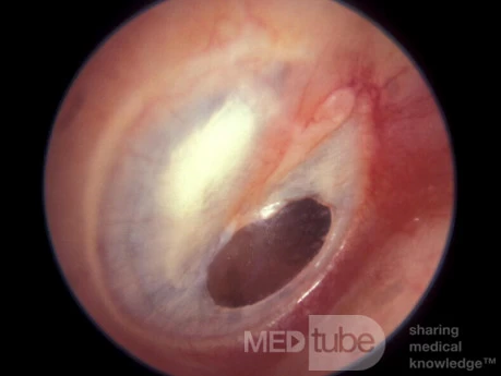 Healed Central Perforation