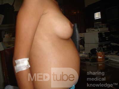 Gastric Cancer (9 of 15)