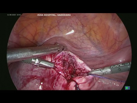 Laparoscopic Cystic Adenomyoma