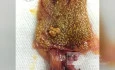 Cholesterolosis