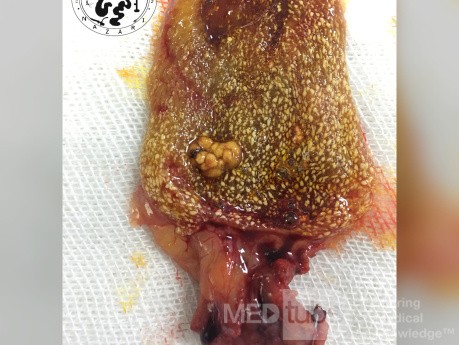 Cholesterolosis