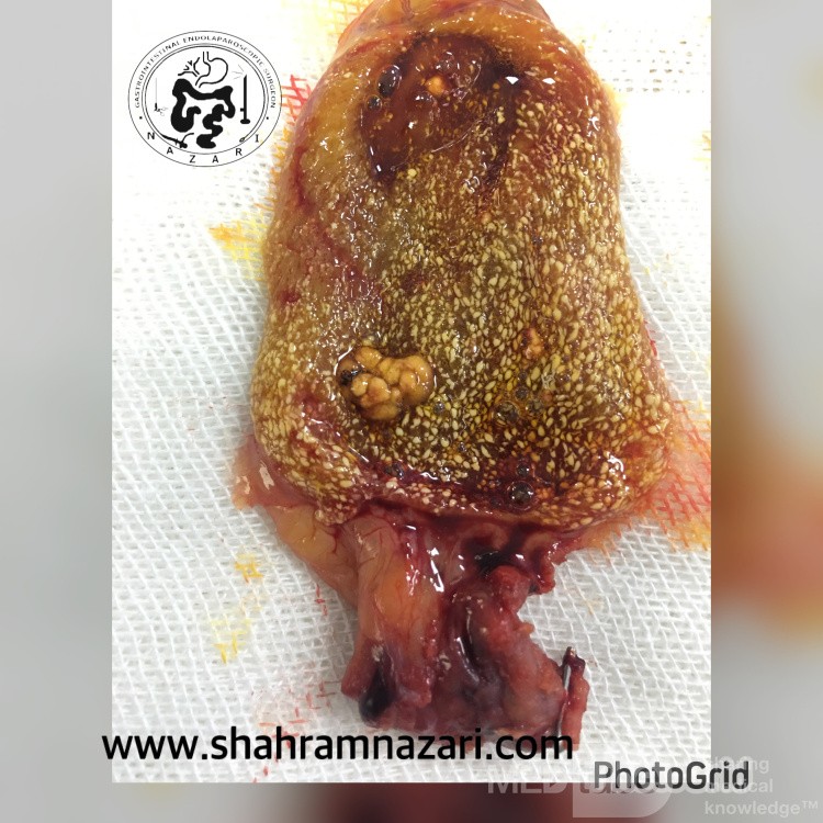 Cholesterolosis