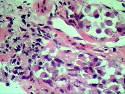 ScirrhousGastric Carcinoma (Linitis Plastica) (15 of 15)