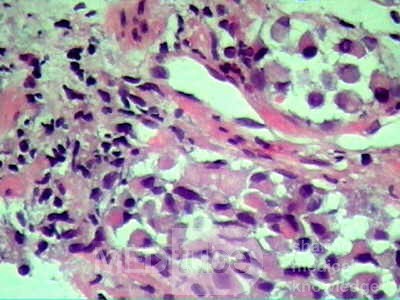ScirrhousGastric Carcinoma (Linitis Plastica) (15 of 15)