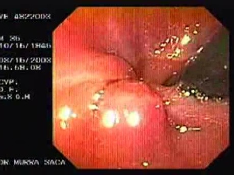 Flexible Endoscopic Suturing - Withdrawal of the Clamp