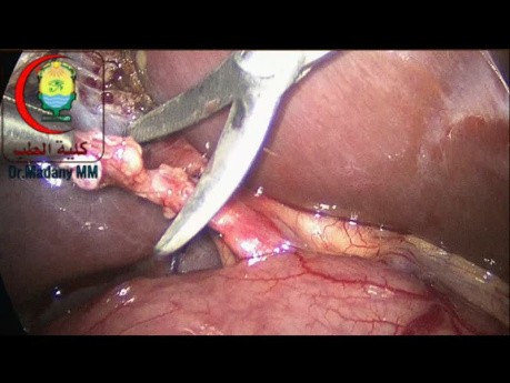 To Apply Your Clip or Ligature Snugged with CBD or to Leave Short Cystic Duct Stump