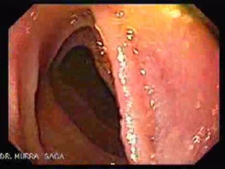 Duodenum