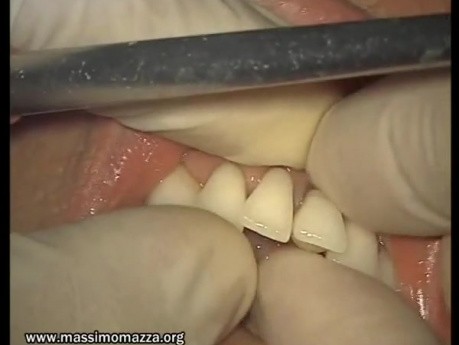 Glass Ionomer Cementation (5/6)