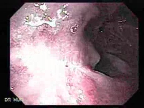 Long Standing Alcohol Abuse - Follow Up After Ligation Treatment