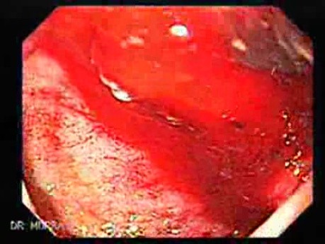 Duodenal Ulcer and Bleeding (1 of 23)
