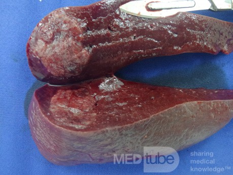 Spleen Tumor