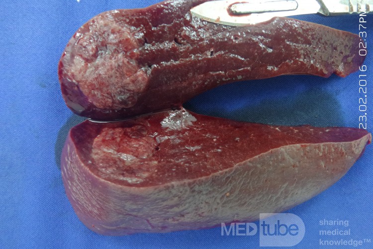 Spleen Tumor