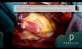 In the Cardiac OR with PARALLEL Medical