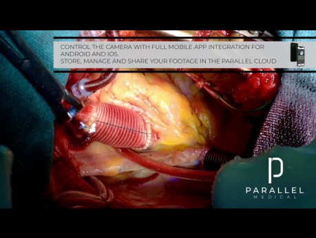 In the Cardiac OR with PARALLEL Medical