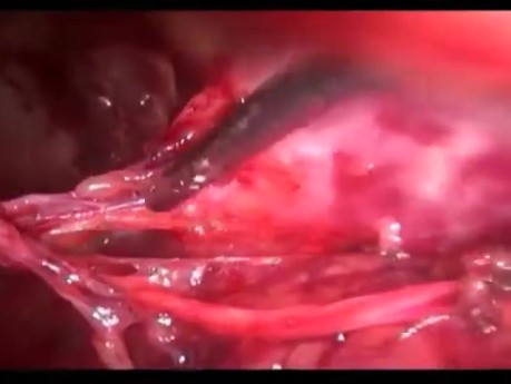 Grynfeltt Lumbar Hernia Treated by Minilaparoscopy
