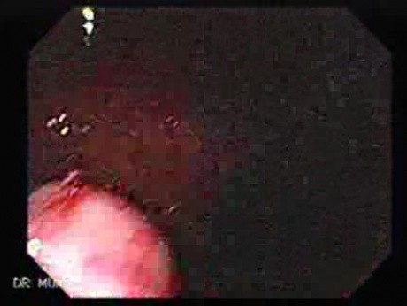 Hyperplastic Polyps - Endoscopy (10 of 14)