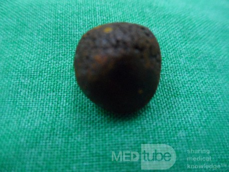 CBD stone removed surgically