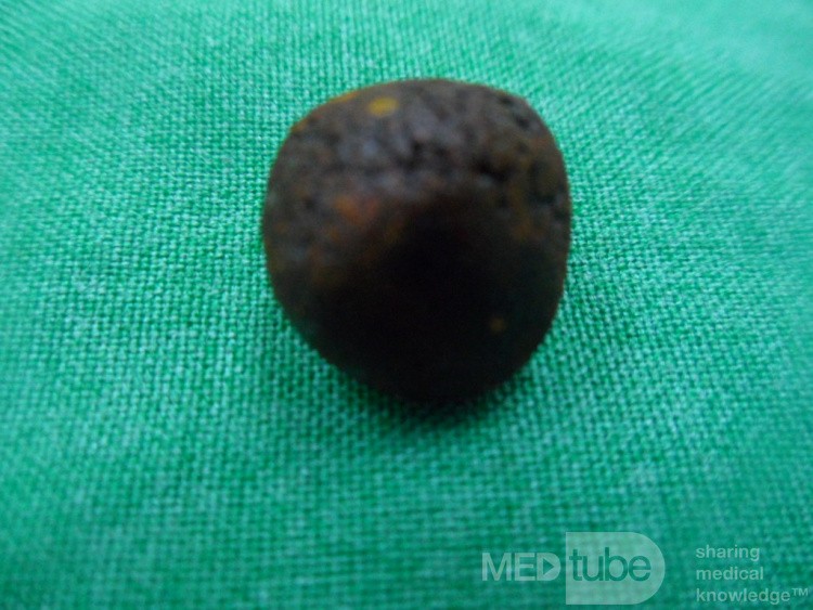 CBD stone removed surgically