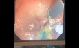 Ampulectomy