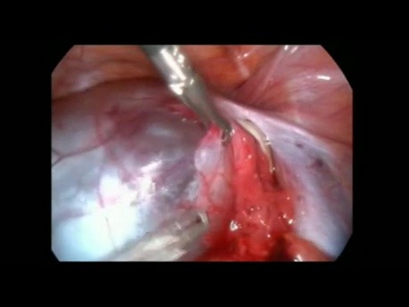 Laparoscopic Paratubal Cystectomy