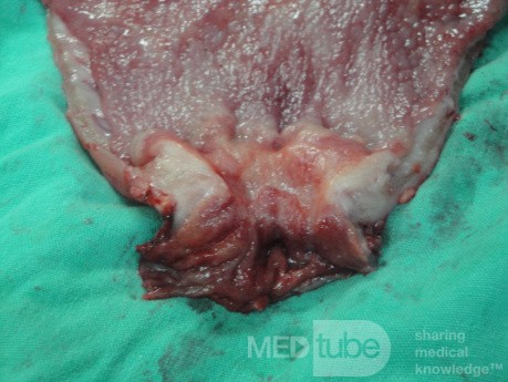 Gastric Ulcerated Adenocarcinoma of the Pre-pyloric Antrum (26 of 28)