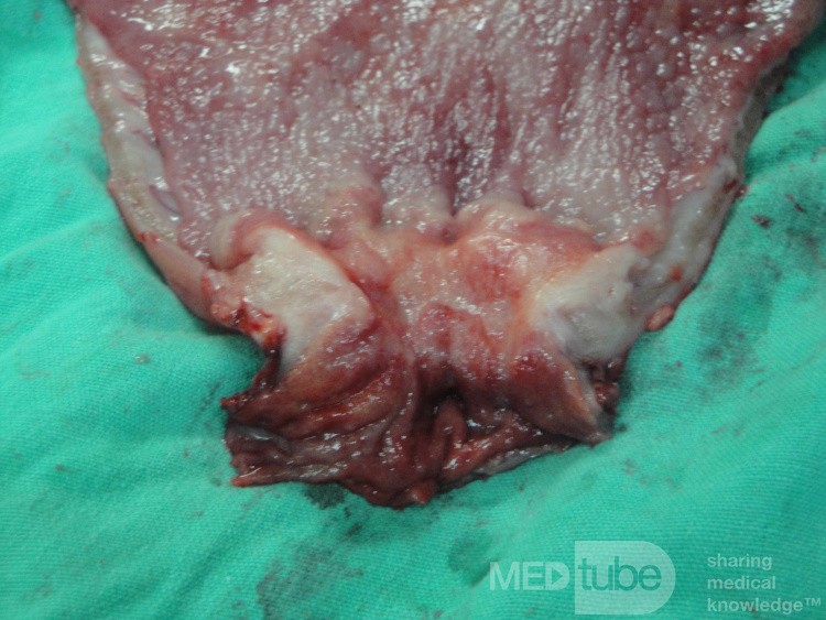Gastric Ulcerated Adenocarcinoma of the Pre-pyloric Antrum (26 of 28)