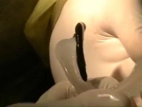 Denture Border Molding And Final Impression