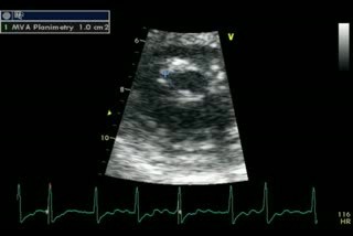 Mitral Stenosis