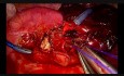 Double Bronchial and Vascular Sleeve Uniportal VATS Left Upper Lobectomy