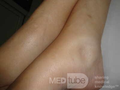 Multiple Rectal Ulcers (31 of 110)