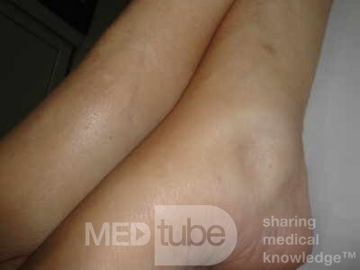 Multiple Rectal Ulcers (31 of 110)