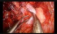Uniportal Vats Intrapericardial Bilobectomy With Superior Cava Vein Partial Resection